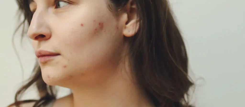 ciclo hormonal feminino e relação com a acne adulta